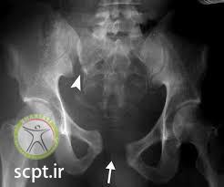 http://scpt.ir/uploads/pelvic fracture X Ray.jpg