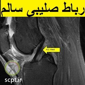 http://scpt.ir/uploads/photo-of-cruciate-ligament-rupture-2.jpg