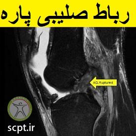 http://scpt.ir/uploads/photo-of-cruciate-ligament-rupture-3.jpg