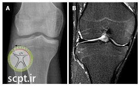 http://scpt.ir/uploads/photo-of-cruciate-ligament-rupture-radiology.jpg