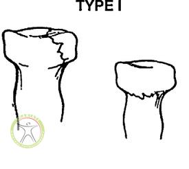 http://scpt.ir/uploads/radial-head-fracture-Mason-classification-type-1.jpg