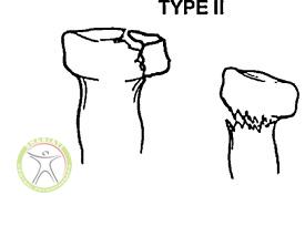 http://scpt.ir/uploads/radial-head-fracture-Mason-classification-type-2.jpg