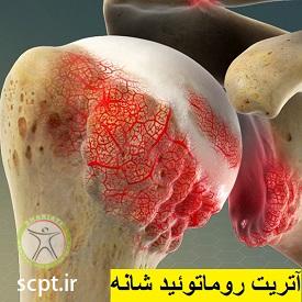 http://scpt.ir/uploads/rheumatoid-arthritis-shoulder.jpg