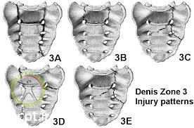 sacral fracture denis 