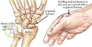 http://scpt.ir/uploads/scaphoid fracture anatomy.jpg