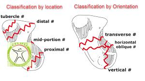 http://scpt.ir/uploads/scaphoid fracture classifications.png