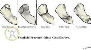 http://scpt.ir/uploads/scaphoid fracture mayo classification.jpg
