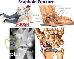http://scpt.ir/uploads/scaphoid fracture mechanism foosh.jpg