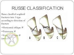 http://scpt.ir/uploads/scaphoid fracture russe classification.jpg