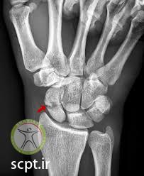 http://scpt.ir/uploads/scaphoid fracture x ray.jpg