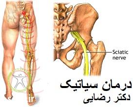 http://scpt.ir/uploads/sciatic-pain-physiotherapy-treatment.jpg