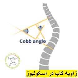 http://scpt.ir/uploads/scoliosis-cobb-angle.jpg