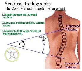 http://scpt.ir/uploads/scoliosis-measurement.jpg