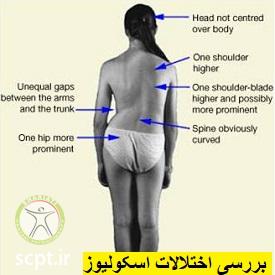 http://scpt.ir/uploads/scoliosis-posture.jpg