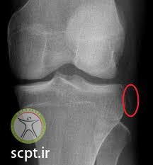 segond fracture acl