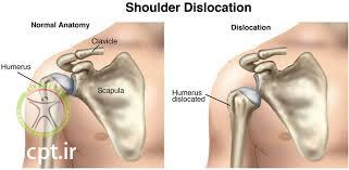http://scpt.ir/uploads/shoulder dislocation 1.jpg