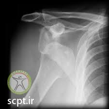 http://scpt.ir/uploads/shoulder dislocation diagnosis.jpg