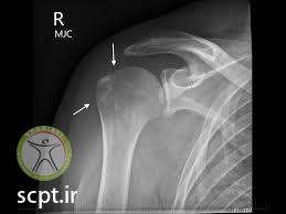 http://scpt.ir/uploads/shoulder dislocation tubercle fracture.jpg