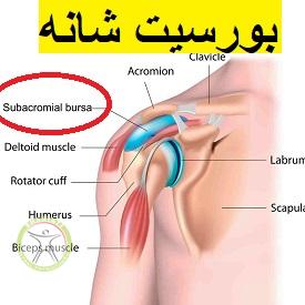 http://scpt.ir/uploads/shoulder-bursitis-subacromial.jpg