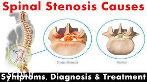http://scpt.ir/uploads/spinal stenosis causes.jpg