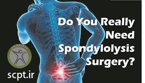 http://scpt.ir/uploads/spondylolisthesis surgery 2.jpg