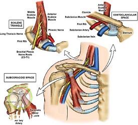 http://scpt.ir/uploads/thoracic-outlet-syndrome-1.jpg