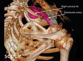 http://scpt.ir/uploads/thoracic-outlet-syndrome-congenital.jpg