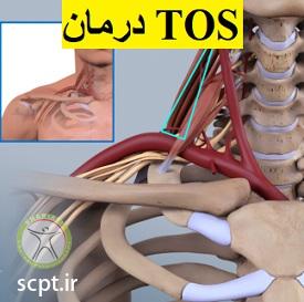 http://scpt.ir/uploads/thoracic-outlet-syndrome-treatment.jpg