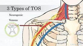 http://scpt.ir/uploads/thoracic-outlet-syndrome-types.jpg