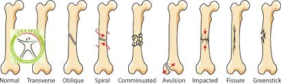 fracture type physiotherapy 